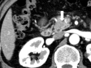 膵臓がんの症例 造影CT画像 腫瘍の指摘は困難です