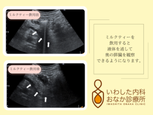  膵臓の超音波検査「通称：ミルクティーエコー☕」 当院では、ミルクティーを用いた膵臓超音波検査を実施しています！ 膵臓を詳しく観察することができます 通常の腹部エコー検査は​、胃内の空気などが超音波を遮るため膵臓の一部が見えにくいという課題があります。 その課題の解決のためにミルクティーを飲用して胃内を液体で満たす「ミルクティーエコー」を導入しています。​ これにより、膵臓の体部や尾部まで観察が可能となり、膵炎や膵臓がんの早期発見につながります。 ​検査は痛みや放射線の心配がなく、安心して受けられます。 こんな方におすすめです！ ・膵炎や膵臓がんのリスクがある方 ・糖尿病や原因不明の腹痛・背中の痛みが続く方 ・喫煙される方、飲酒される方 ・特に理由もなく体重が減少した方 おなかの健康が気になる方は、ぜひ当院へお気軽にご相談ください！ 