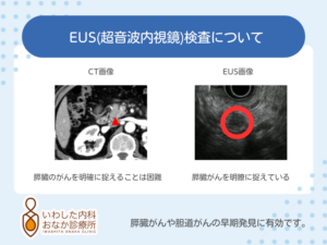 📣EUS（超音波内視鏡検査）のメリット📣 ・膵臓や胆道をより近くから観察することで、非常に細かな変化をとらえることができます ・CTやMRIでも指摘できないような小さな病変（超早期の膵臓がんなど）の発見に役立つ場合があります ・膵のう胞の悪性化の有無など、精密検査としても有用です